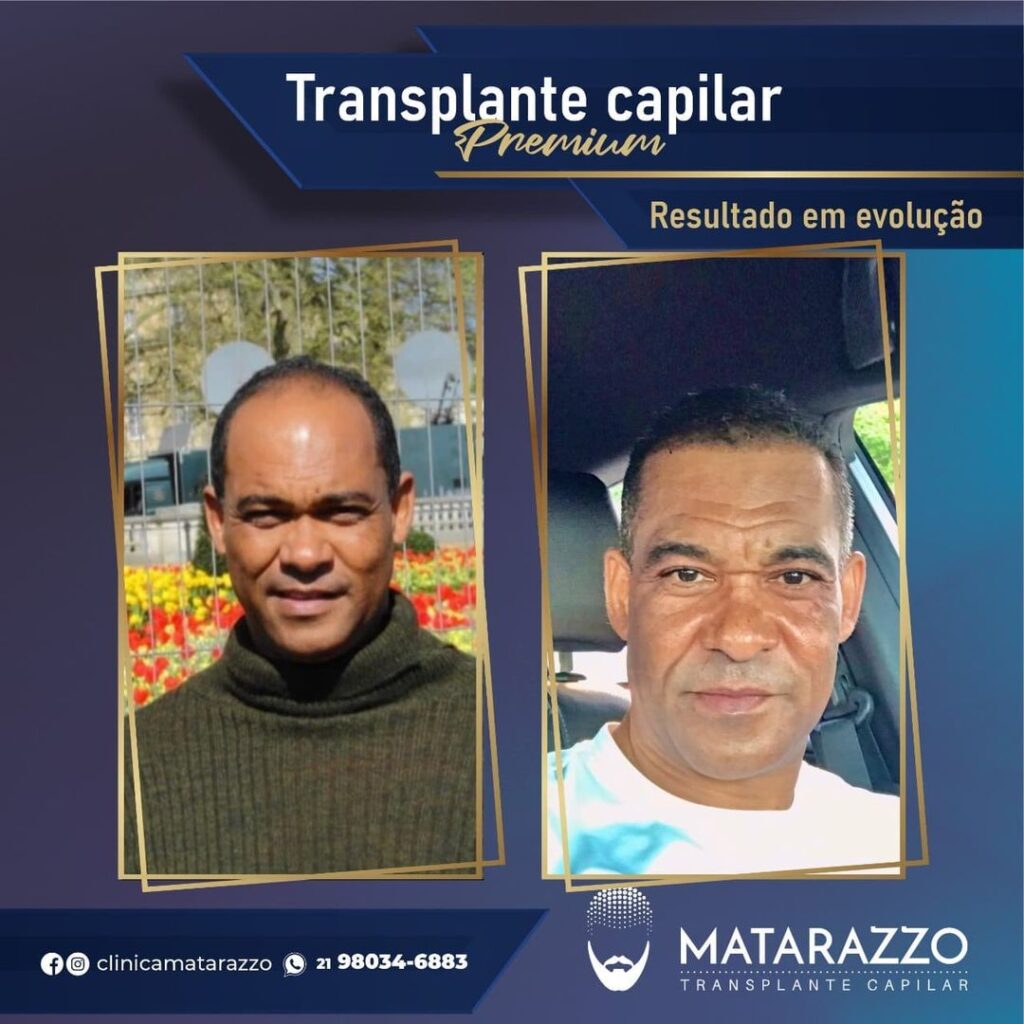 Resultados Matarazzo Transplante Capilar