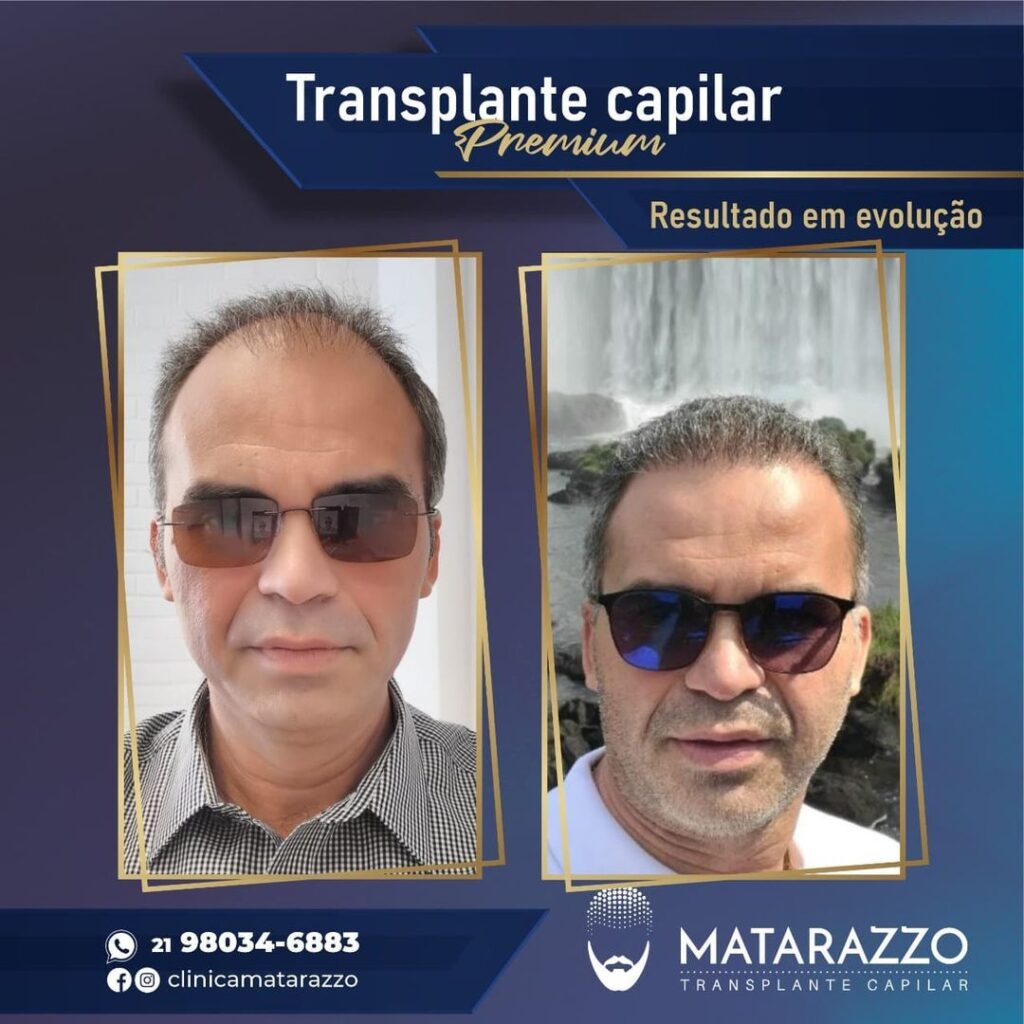 Antes e Depois Matarazzo Transplante Capilar