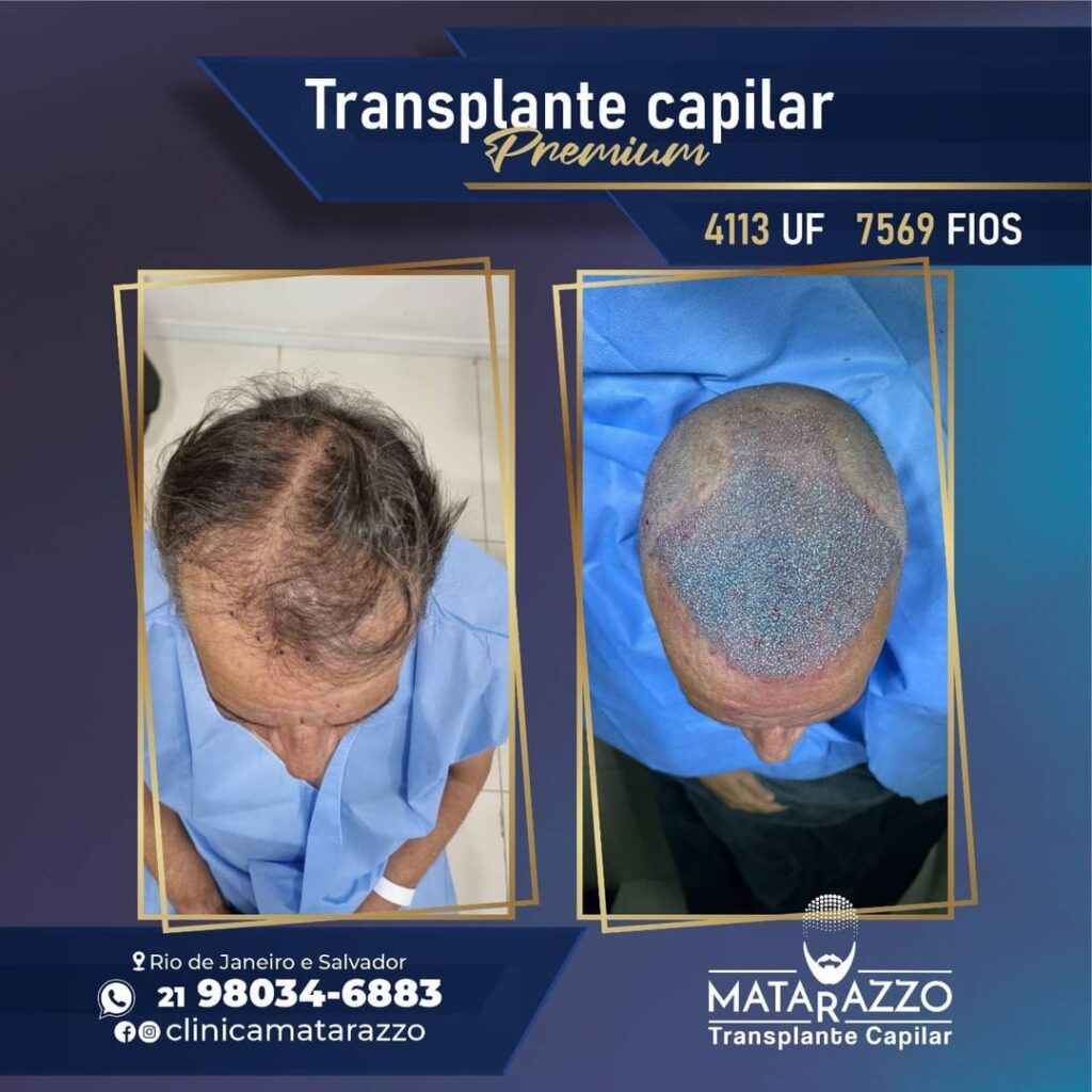 Transplante Capilar na Clinica Matarazzo